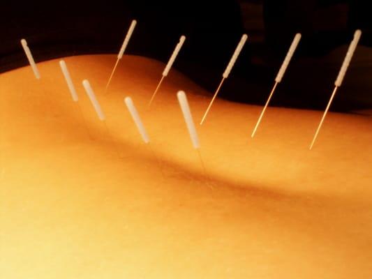 Acupuncture