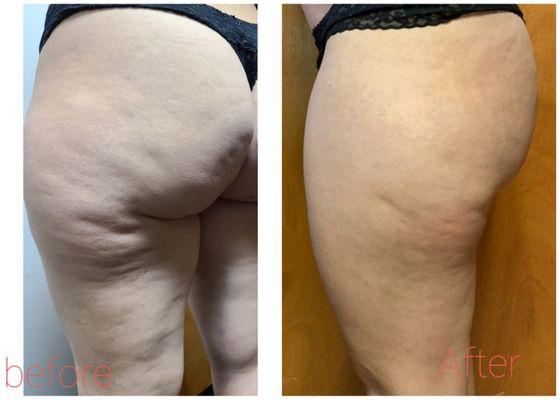 Before & After Cellulite Treatment.