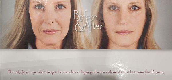 Sculptra the only facial injectable designed to stimulaye collagen productik. with results that last more than 2 years