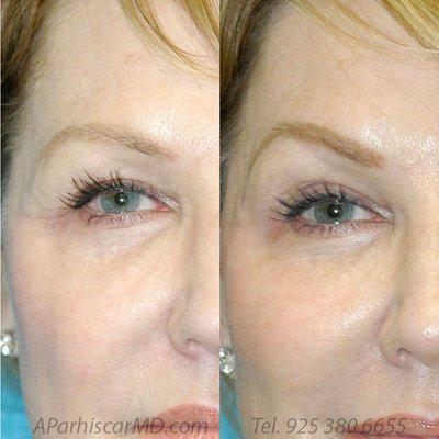 Botox for eyebrow lift, cheek fillers for youthful face