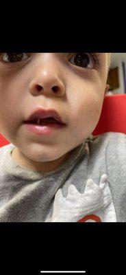 My sons busted lip