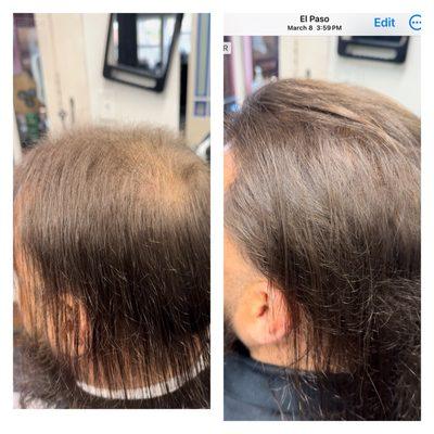 We grow your hair with our customized non-medicated treatments. Start of treatment for this client 12/22/23-03/8/2024 11 weeks.