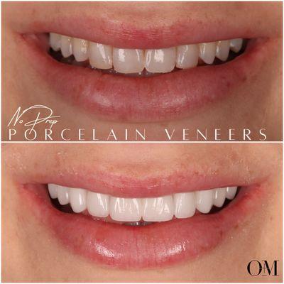 10 Nearly no prep Veneers to brighten the smile and create uniformity