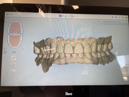 Dr. Ochev scans your teeth with a pen.