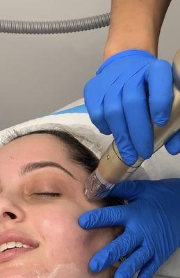 Acne scars and skin texture improvements with Sylfirm X Microneedling with Radiofrequency and Exosomes.