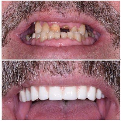 Hybrid Fixed Dentures