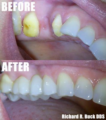 Placing a Dental Bridge to Replace a Missing Tooth.