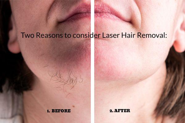 Laser Hair Solutions And Electrolysis