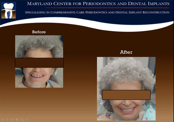 Same Day Smile Dental Implant Procedure!