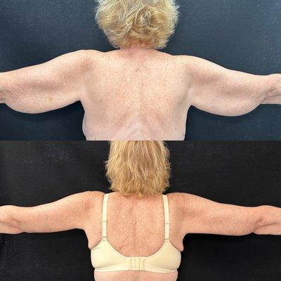 Back View of 
Arm Lift 
Before and After