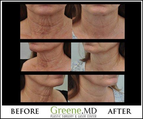 Excellent result for non-surgical tightening and wrinkle reduction of the neck.