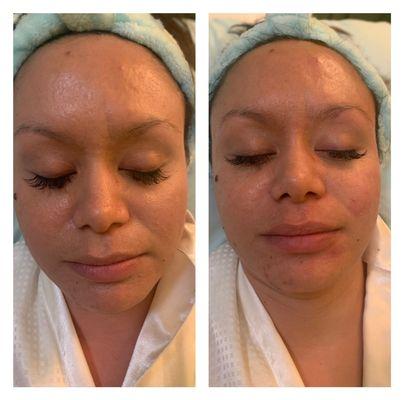 Cleansing facial. Before and after. Hydrated beautiful clean skin!