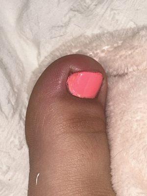 This is my big toe with the ingrown toenail it hurts to touch and it is right around the area