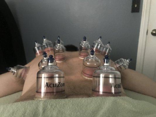 Cupping