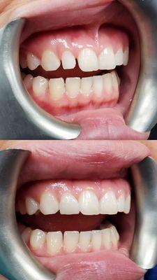 Veneer - before and after. If you want closed spaces but don't want braces. =)