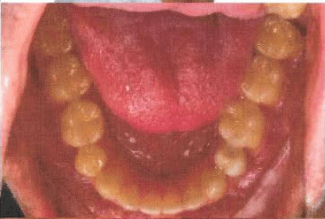 End of an orthodontic treatment.