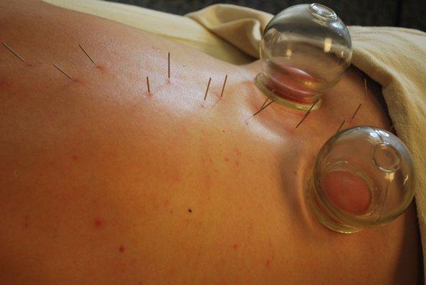 Combining acupuncture with cupping and massage is a necessity for maximum relief.