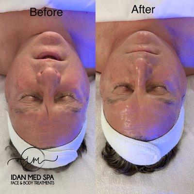 Before and after Non surgical facelift treatment