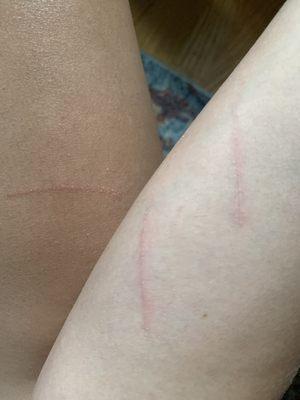 Cuts on my legs and arm from my dog.