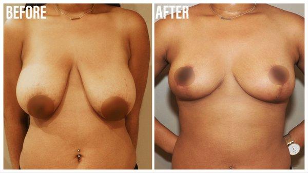 Mastopexy 22 yr old female 5'4" 155lbs disliked the sagging of her breasts & the width of her areola. Also desired a reduction in cup size