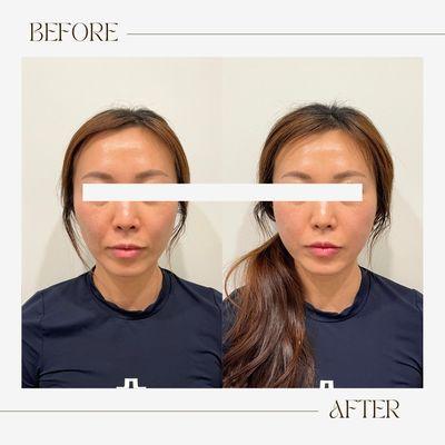 Sculptra before and after.