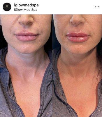 iGlowMedSpa Porter Ranch - Lip Injections Restylane Kysse