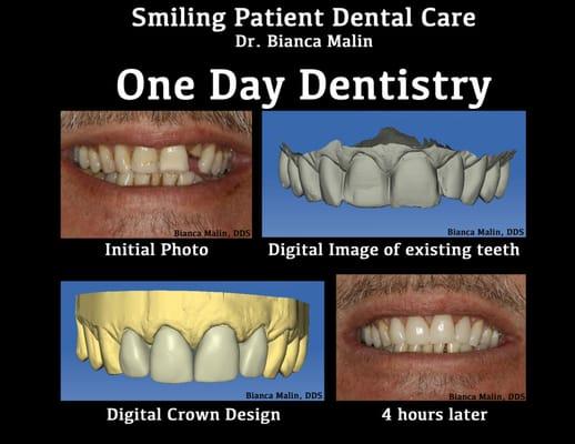 These four front teeth were rebuilt at a single dental appt. After photo is from same day deliver of four crowns.No impressions!