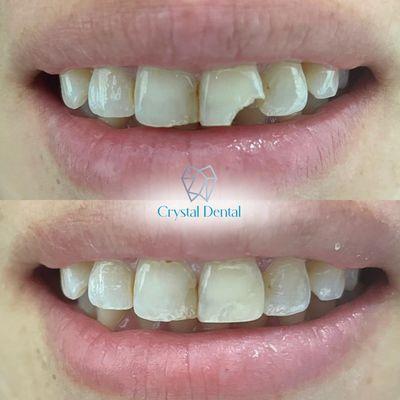 Chipped or damaged tooth? We can help with the composite bonding treatment!