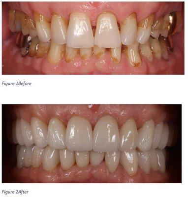 full mouth rehabilitation due to severe erosion