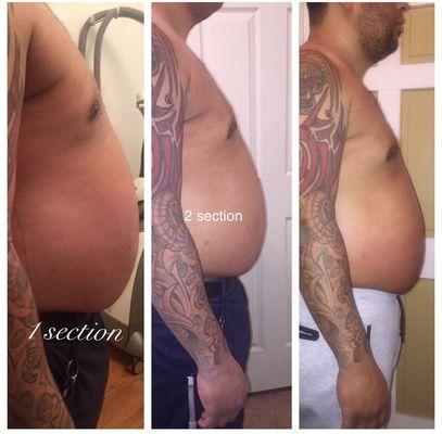 YES!!! MEN CAN GET THERE FAT REDUCTION`S TREATMENT TOO. THIS IS ONLY THE SECOND SECTION 3 MORE TO GO. CONTACT US