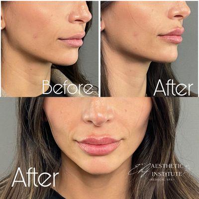 Lip Dissolving and Refilling (Lip Reset Treatment)