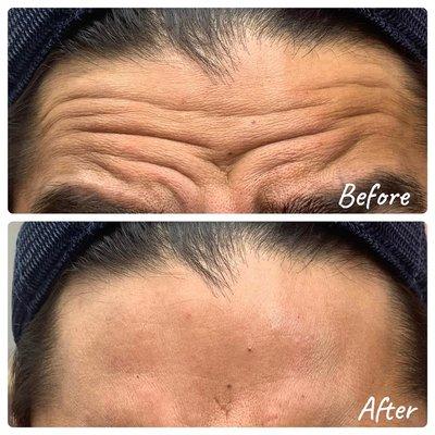 Anti wrinkle injections( Botox) for forehead lines