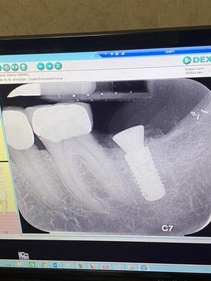 Before and after implant