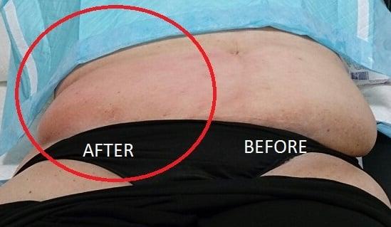 Mesotherapy - Fat Reduction