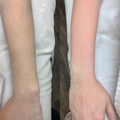 Before and after for first time arm sugaring