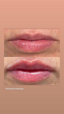 Juvederm lip filler!