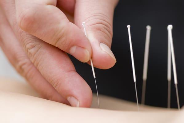 Ask our doctor for acupuncture