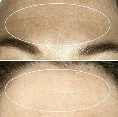 Before and After Hydrodermabrassion Facial