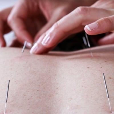 acupuncture to treat pain, injuries, or internal disorders such as insomnia, depression, headaches/migraines, etc.