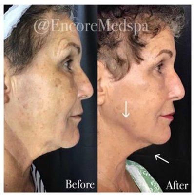 3 months post Ultherapy treatment of the lower face and neck result in a jaw dropping jawline for this patient.