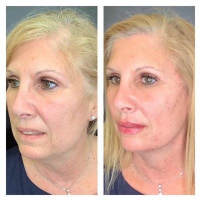 Full face rejuvenation