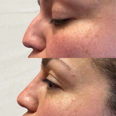 Nonsurgical Rhinoplasty