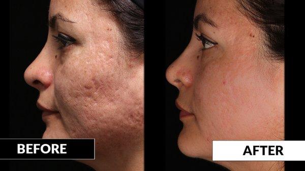 De-Pigmentation system for melasma and hyperpigmentation