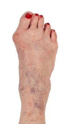 Bunion deformity - Orange County Foot and Ankle Surgeon Podiatrist - Irvine, CA Podiatrist - Huntington Beach, CA