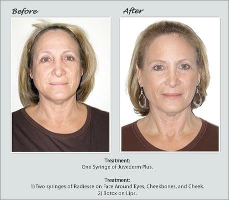 Facial Enhancements by Reva Frey RN