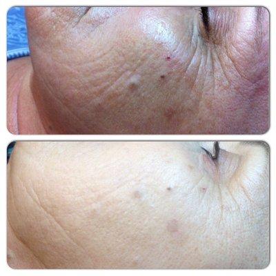 Ageless facial , chemical peel