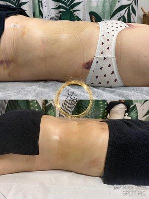 Before & After lymphatic drainage post surgery, text
347 251 1605
ADRESS:
311 85th Street BKLYN NY 11209
Bay Ridge 
Instagram: