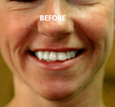 Smile change - Before