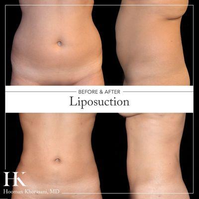 https://www.drkhorasani.com/before-and-after-gallery/liposuction