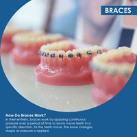 Braces - Alvin Smiles Alvin  Texas